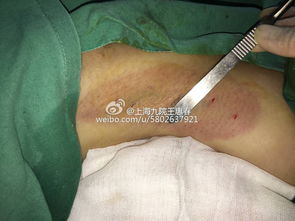 微切口 1厘米直视下腋臭根除术 ,图片几张 手术