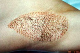 治疗狐臭最佳年龄 专家为你解难题