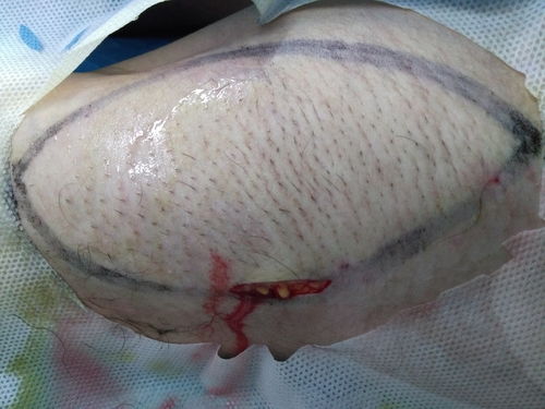 微创腋臭根治术