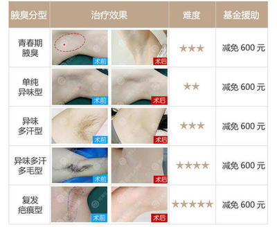 腋臭的搜索结果_图片