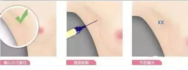 人民医院:黄金微针腋臭治疗仪,带你告别夏季尴尬