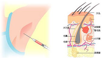 深圳微波一次性一次性祛腋臭 狐臭 治疗腋臭狐臭方法技术医院