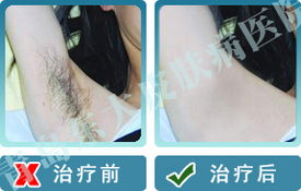 祛除身体异味，还你清香肌肤——威海皮肤病医院专业治疗狐臭