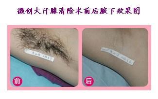 电离子去腋臭手术的原理、方法与治疗优势