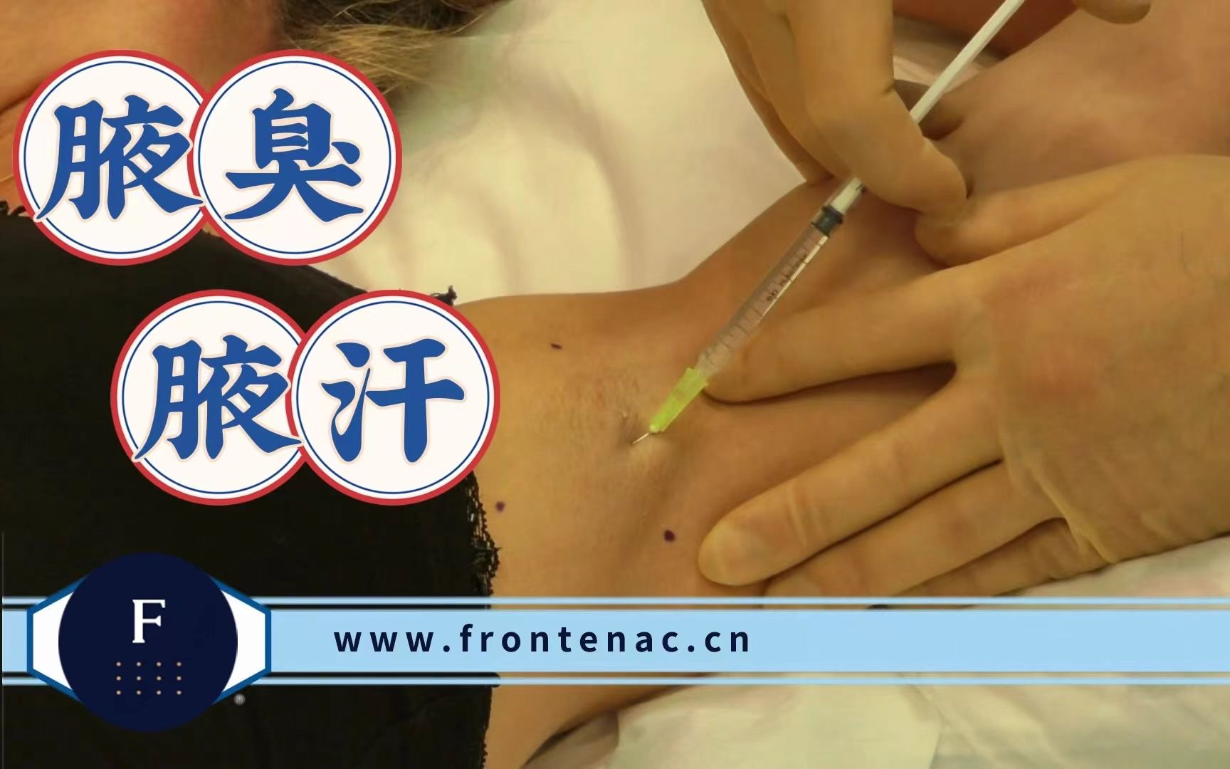 注射演示 保妥适肉毒素，快速无创的腋下异味与多汗解决方案