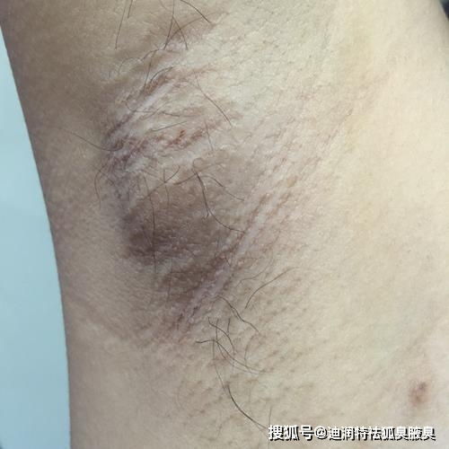 狐臭产品哪个好？注意这几点，别再选错治疗狐臭产品了
