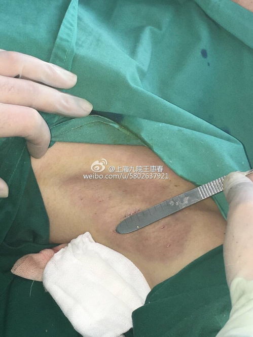 微切口1厘米直视下腋臭根除术 原理、过程与效果图解